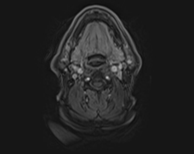 File:Non-Hodgkin lymphoma - parotid gland (Radiopaedia 71531-81890 E 30).jpg