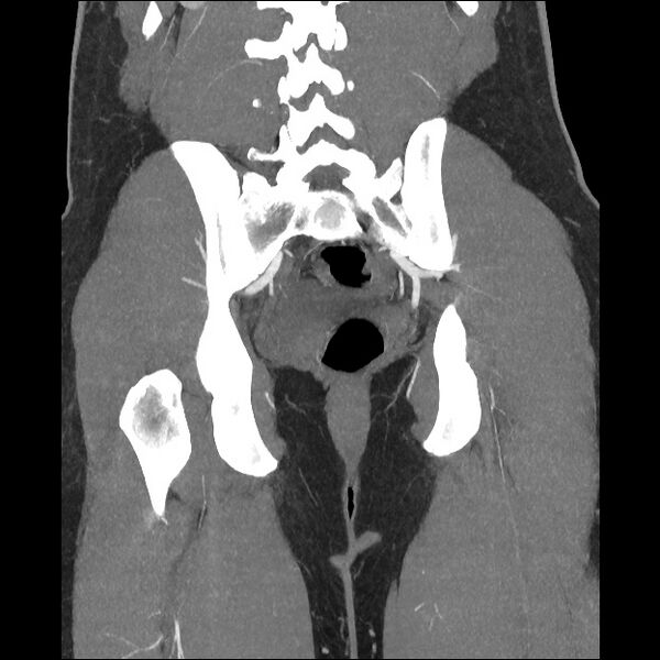 File:Normal CT angiogram of pelvis (Radiopaedia 45390-49430 B 33).jpg