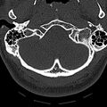 Normal CT of the cervical spine (Radiopaedia 53322-59305 Axial bone window 31).jpg