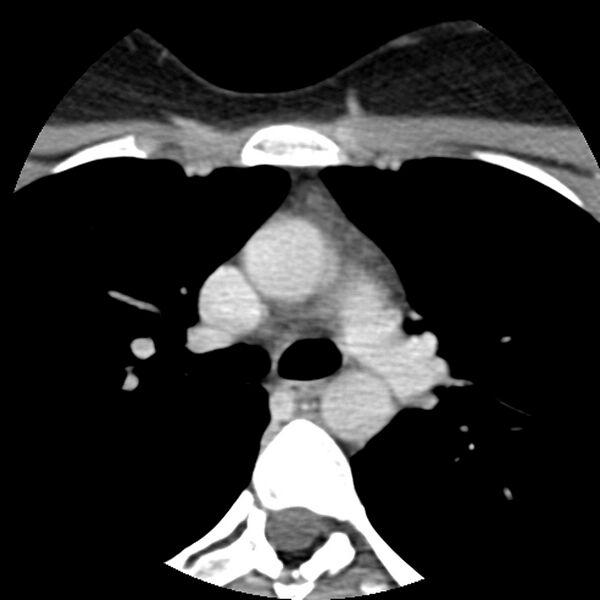 File:Normal CT of the neck (Radiopaedia 14575-14500 Axial C+ 83).jpg