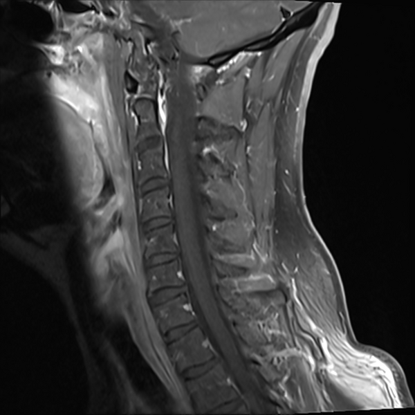 File:Normal MRI cervical spine (infection protocol) (Radiopaedia 53916-60039 I 5).png