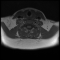 Normal cervical and thoracic spine MRI (Radiopaedia 35630-37156 Axial T1 13).png