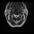 Normal cervical and thoracic spine MRI (Radiopaedia 35630-37156 Axial T2 26).png