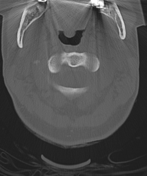 File:Normal cervical spine MRI (including Dixon) (Radiopaedia 42762-45926 Axial bone window 14).png