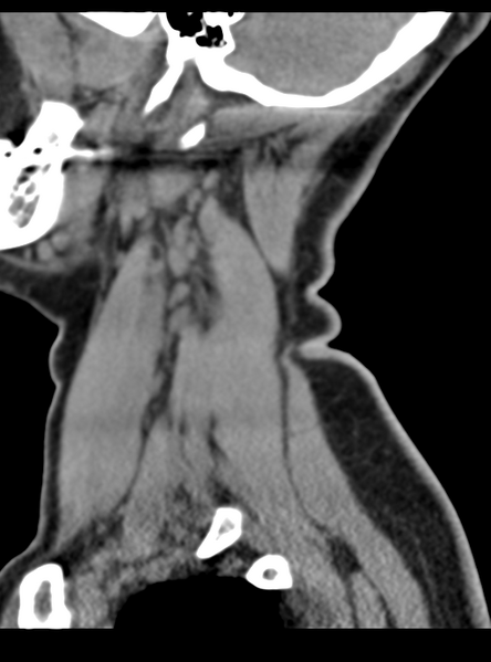 File:Normal cervical spine MRI (including Dixon) (Radiopaedia 42762-45926 C 7).png