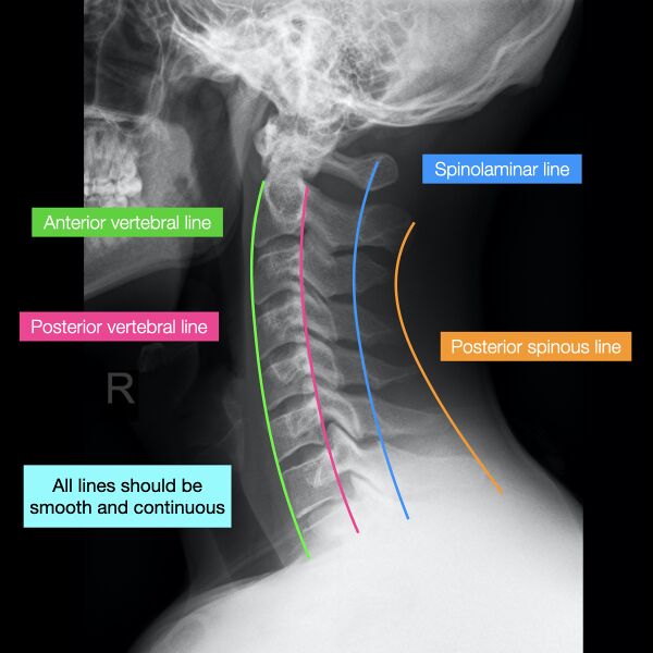 File:Normal cervical spine radiographs (Radiopaedia 32505-96698 Lateral 2).jpeg