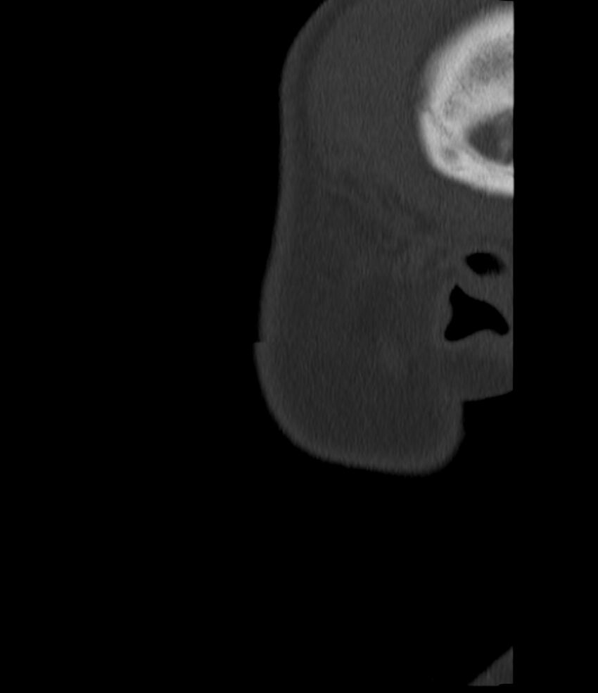 Normal facial bone CT (Radiopaedia 88742-105476 Sagittal bone window 14).jpg