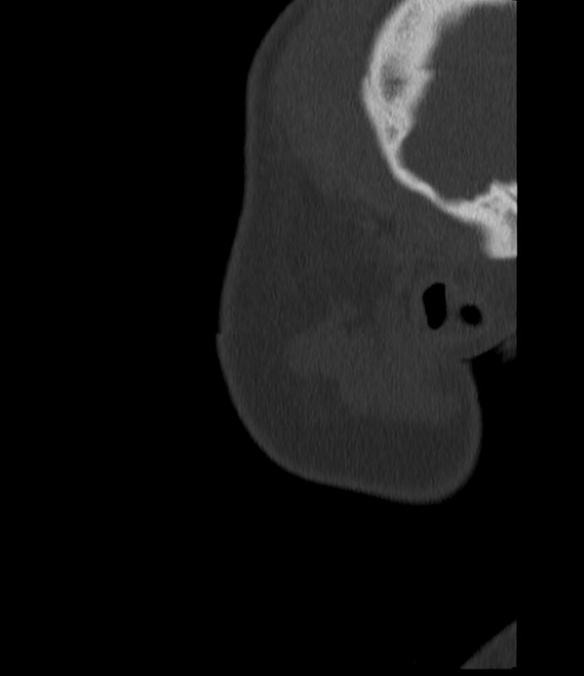 Normal facial bone CT (Radiopaedia 88742-105476 Sagittal bone window 18).jpg