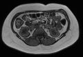 Normal liver MRI with Gadolinium (Radiopaedia 58913-66163 B 10).jpg