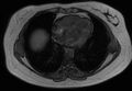 Normal liver MRI with Gadolinium (Radiopaedia 58913-66163 B 32).jpg