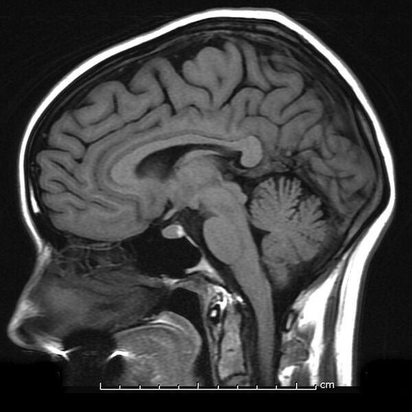File:Normal midline brain (MRI) (Radiopaedia 9878).jpeg