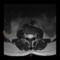 Normal spine MRI (Radiopaedia 77323-89408 Axial T2 5).jpg