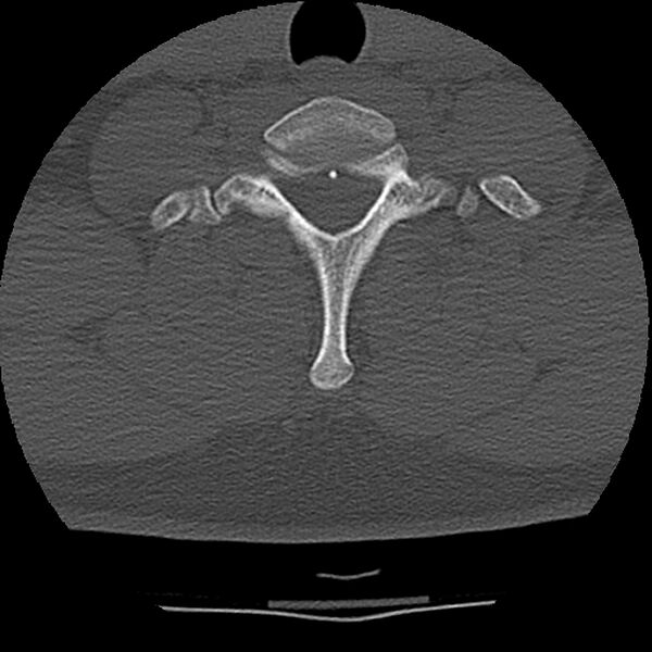 File:Normal trauma spine imaging (Radiopaedia 31753-32686 Axial bone window 71).jpg