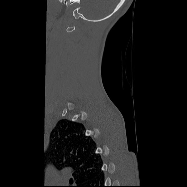 File:Normal trauma spine imaging (age 16) (Radiopaedia 45335-49358 Sagittal bone window 2).jpg