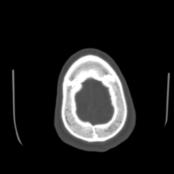 File:Occipital spur - asymptomatic (Radiopaedia 87753-104201 Axial bone window 198).jpg