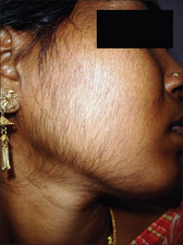 Steroid-induced hypertrichosis