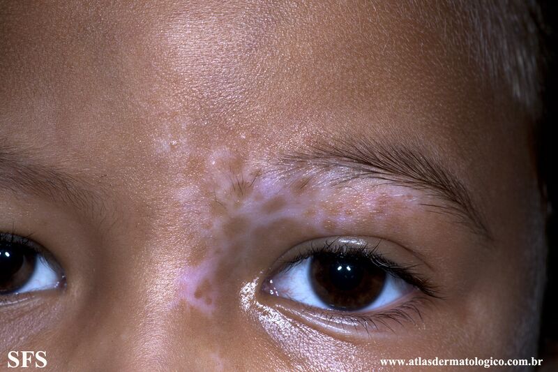 File:Vitiligo (Dermatology Atlas 46).jpg