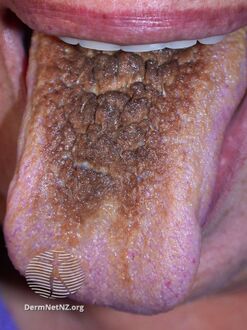 Smoker's tongue