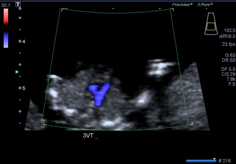 File:1st trimester nuchal-morphology ultrasound (Radiopaedia 44706-48477 General anatomy and NT 23).jpg