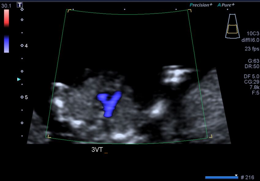 1st trimester nuchal-morphology ultrasound (Radiopaedia 44706-48477 General anatomy and NT 23).jpg