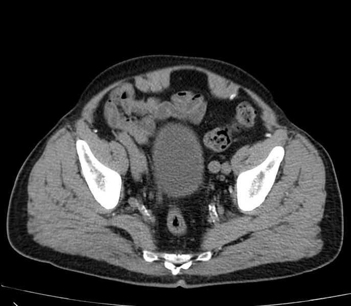 File:Abdominal aortic aneurysm (Radiopaedia 22421-22458 non-contrast 48).jpg