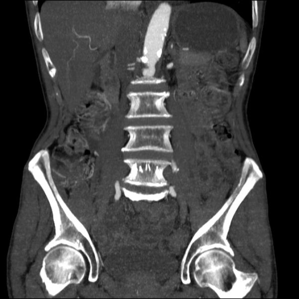 File:Abdominal aortic aneurysm (Radiopaedia 23703-23856 Coronal C+ arterial phase 15).jpg