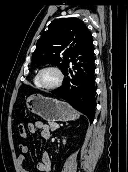 File:Abdominal aortic aneurysm (Radiopaedia 83094-97462 Sagittal renal cortical phase 85).jpg