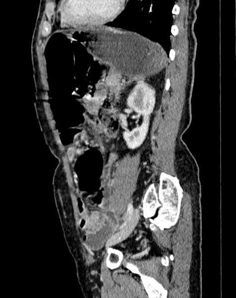 File:Abdominal aortic aneurysm (Radiopaedia 83581-98689 Sagittal C+ portal venous phase 87).jpg
