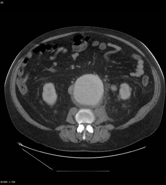 File:Abdominal aortic aneurysm with intramural hematoma then rupture (Radiopaedia 50278-55631 Axial C+ arterial phase 79).jpg