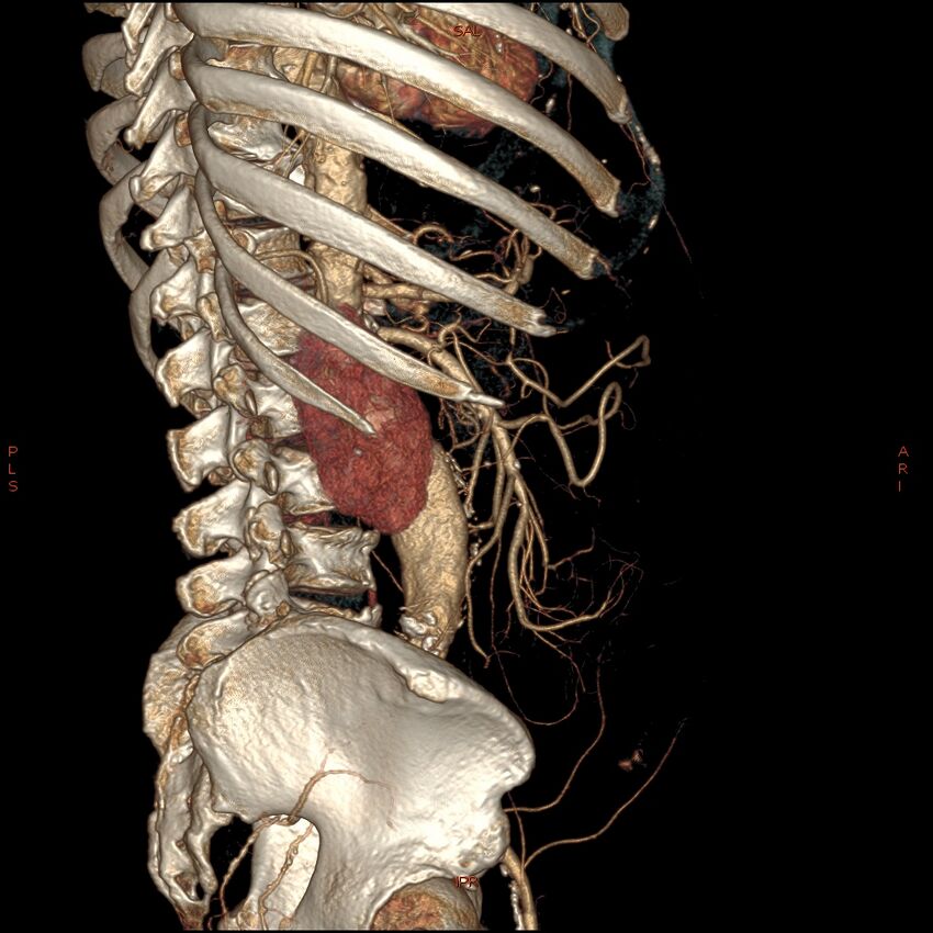 Abdominal aortic aneurysm with intramural hematoma then rupture (Radiopaedia 50278-55632 Axial C+ arterial phase 66).jpg