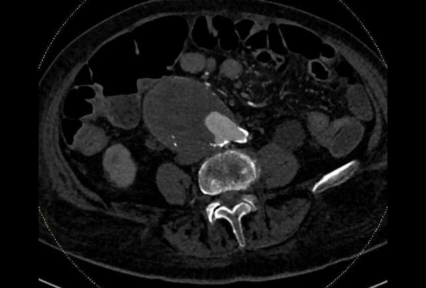 Abdominal aortic aneurysm with thrombus fissuration (Radiopaedia 73192-83919 Axial C+ arterial phase 131).jpg