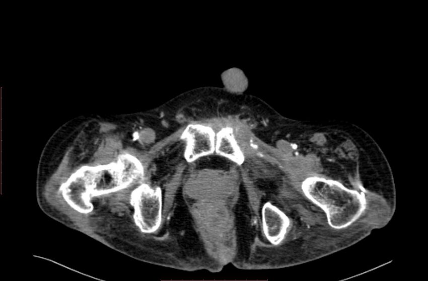 Abdominal aortic interposition tube graft and aneurysm thrombosis (Radiopaedia 71438-81857 Axial C+ arterial phase 250).jpg