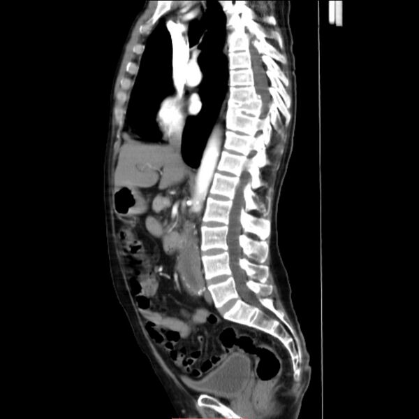 File:Abdominal aortic interposition tube graft and aneurysm thrombosis (Radiopaedia 71438-81857 Sagittal C+ arterial phase 17).jpg