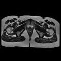 Abdominal wall endometriosis (Radiopaedia 83702-98847 Axial T2 18).jpg