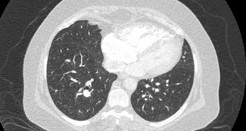 File:Accessory right inferior hepatic vein (Radiopaedia 65245-74259 Axial lung window 52).jpg