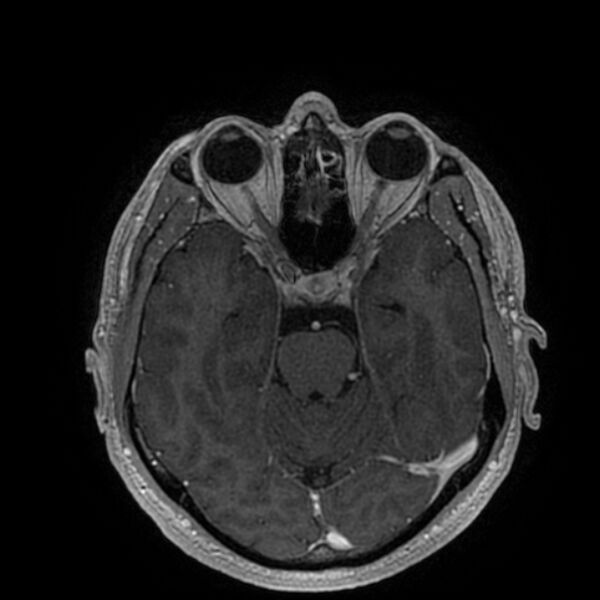File:Acoustic schwannoma - intracanalicular (Radiopaedia 37247-39024 Axial T1 C+ 95).jpg