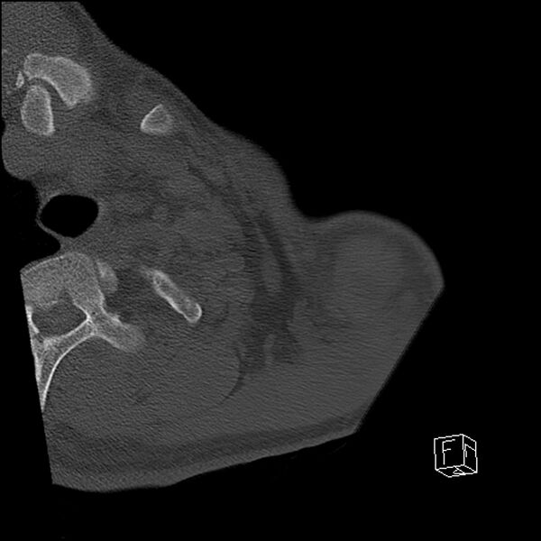 File:Acromioclavicular joint dissociation - type IV (Radiopaedia 64411-73216 Axial bone window 3).jpg