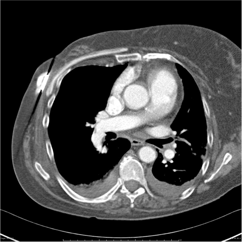 Acute-on-chronic pulmonary emboli (Radiopaedia 27925-28169 C+ CTPA 40).jpg