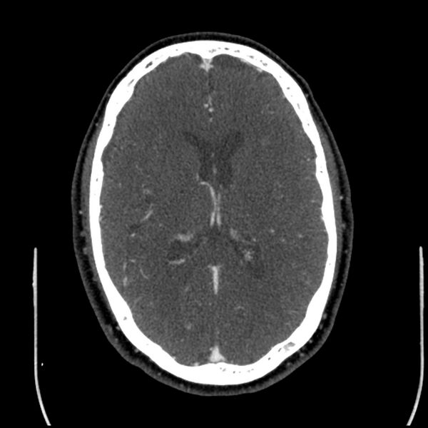 File:Acute A3 occlusion with ACA ischemic penumbra (CT perfusion) (Radiopaedia 72036-82527 Axial C+ arterial phase thins 53).jpg