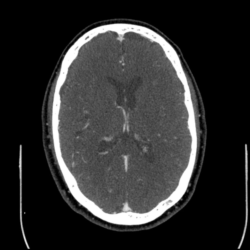 Acute A3 occlusion with ACA ischemic penumbra (CT perfusion) (Radiopaedia 72036-82527 Axial C+ arterial phase thins 53).jpg