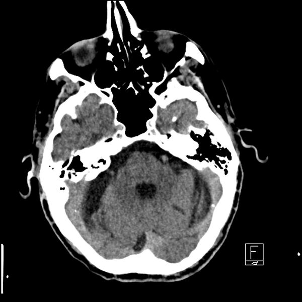 File:Acute ICA ischemic penumbra due to high-grade CCA stenosis (CT perfusion) (Radiopaedia 72038-82529 Axial non-contrast 12).jpg