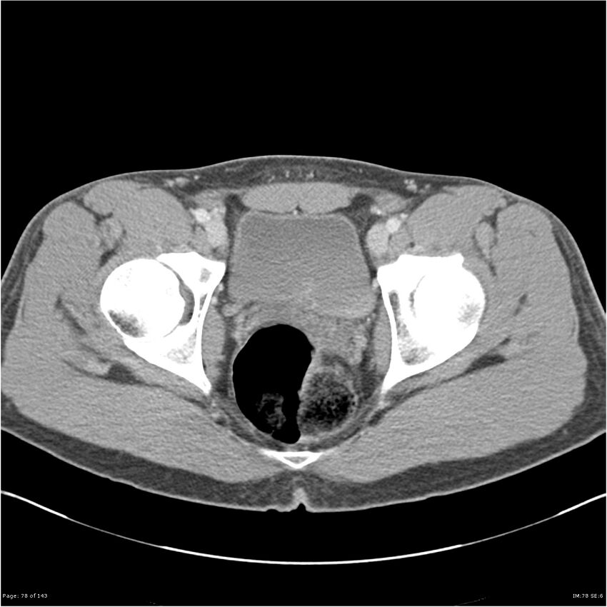 Acute appendicitis (Radiopaedia 25364-25615 B 68).jpg