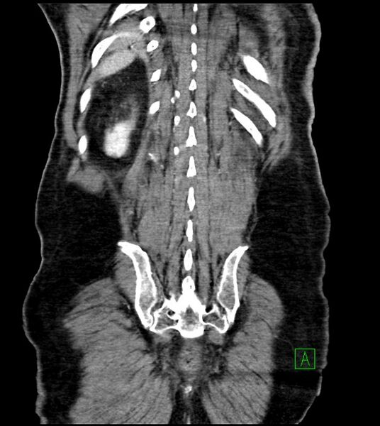 File:Acute arterial mesenteric ischemia (Radiopaedia 78238-90828 Coronal C+ portal venous phase 77).jpg