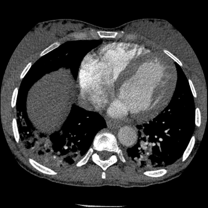Acute chest syndrome - sickle cell disease (Radiopaedia 42375-45499 Axial C+ CTPA 136).jpg