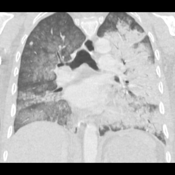 File:Acute diffuse alveolar hemorrhage (Radiopaedia 41323-44158 Coronal lung window 30).jpg