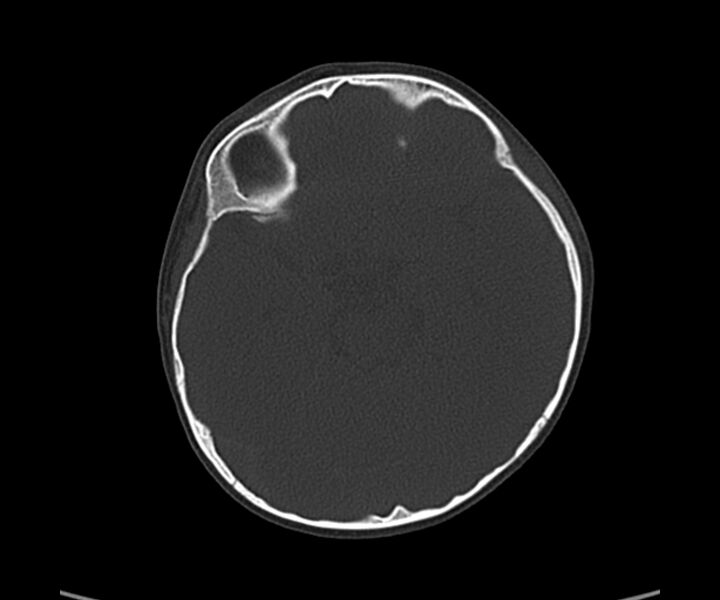 File:Acute hemorrhagic contusion (Radiopaedia 63660-72336 Axial bone window 27).jpg