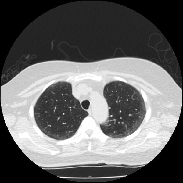 File:Acute interstitial pneumonitis (Radiopaedia 45404-49444 Axial lung window 25).jpg