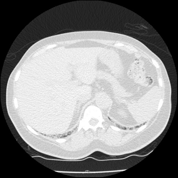 File:Acute interstitial pneumonitis (Radiopaedia 45404-49444 Axial lung window 95).jpg
