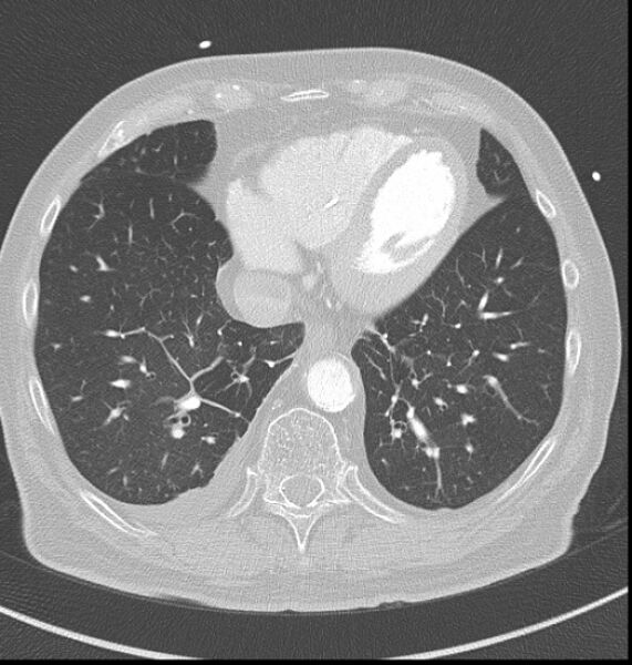 File:Acute myocardial infarction (Radiopaedia 23413-23481 lung window 54).jpg