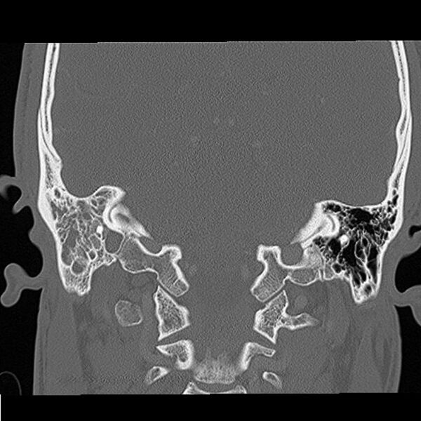 File:Acute otomastoiditis (Radiopaedia 28329-28575 Coronal bone window 6).jpg
